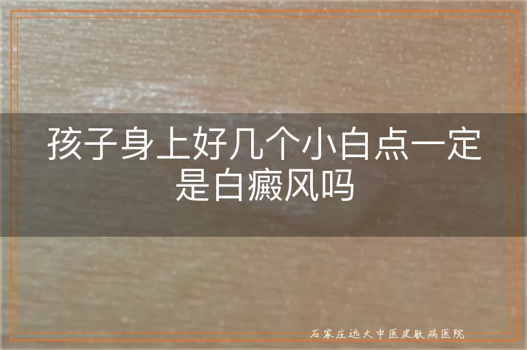 孩子身上好几个小白点一定是白癜风吗