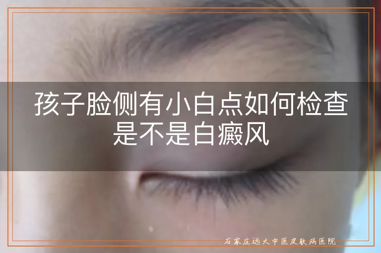孩子脸侧有小白点如何检查是不是白癜风