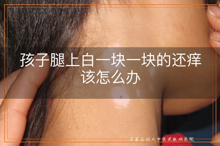 孩子腿上白一块一块的还痒该怎么办