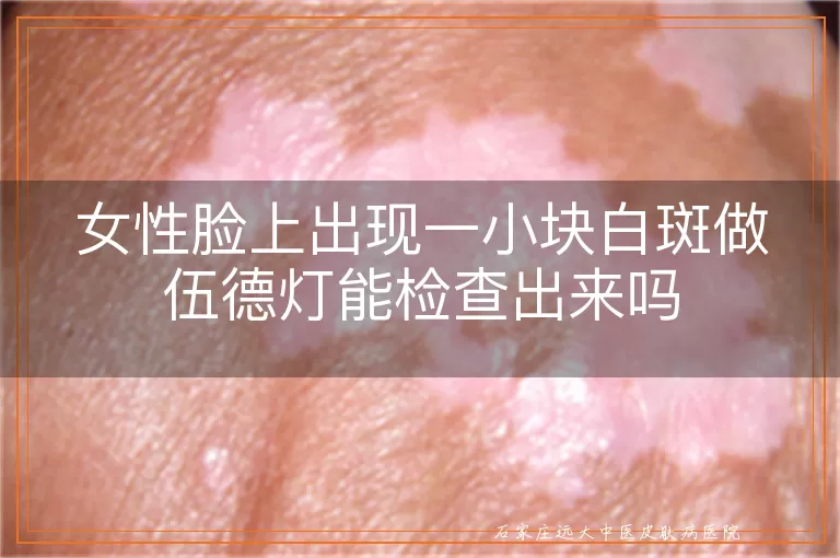 女性脸上出现一小块白斑做伍德灯能检查出来吗