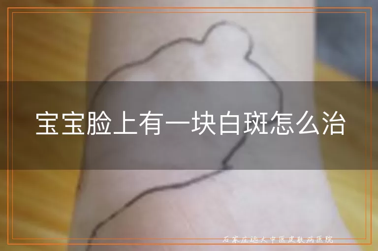 宝宝脸上有一块白斑怎么治