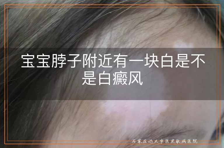 宝宝脖子附近有一块白是不是白癜风