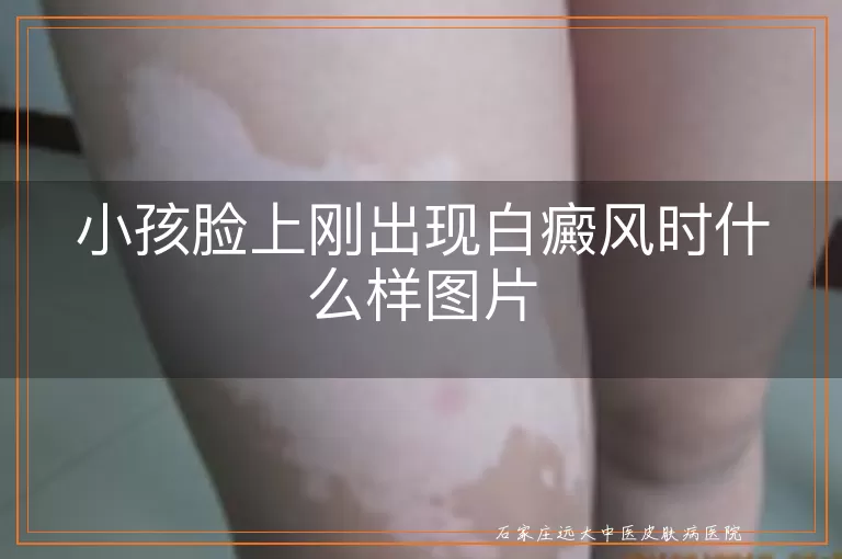 小孩脸上刚出现白癜风时什么样图片