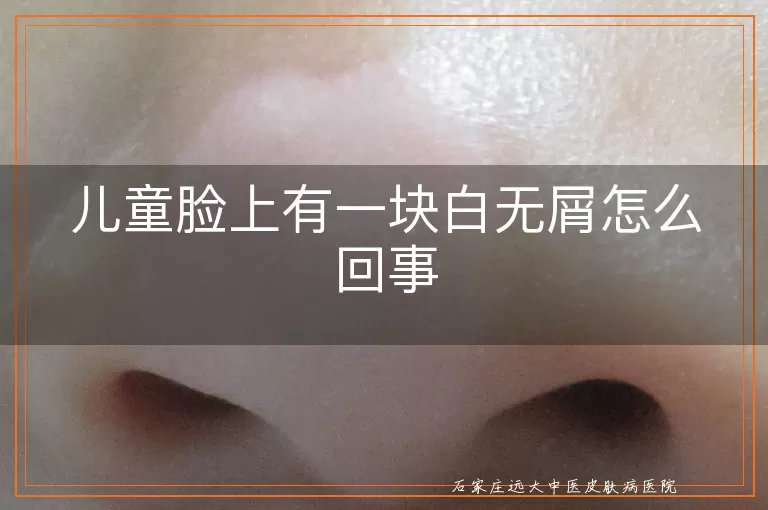 儿童脸上有一块白无屑怎么回事