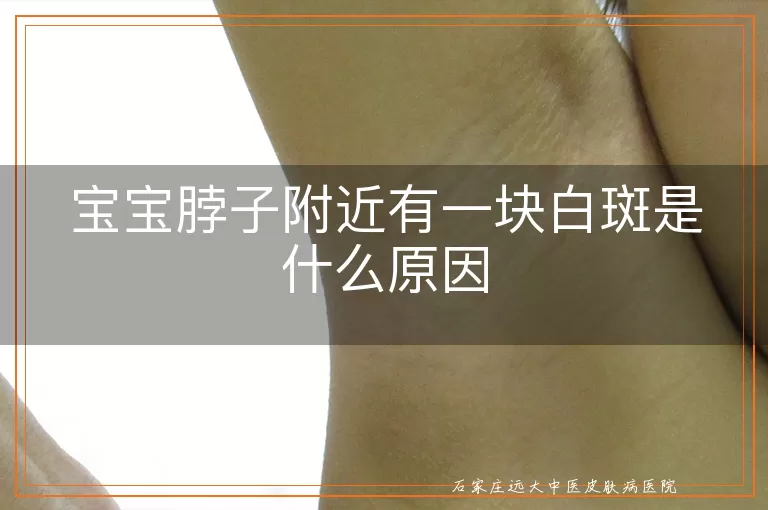 宝宝脖子附近有一块白斑是什么原因