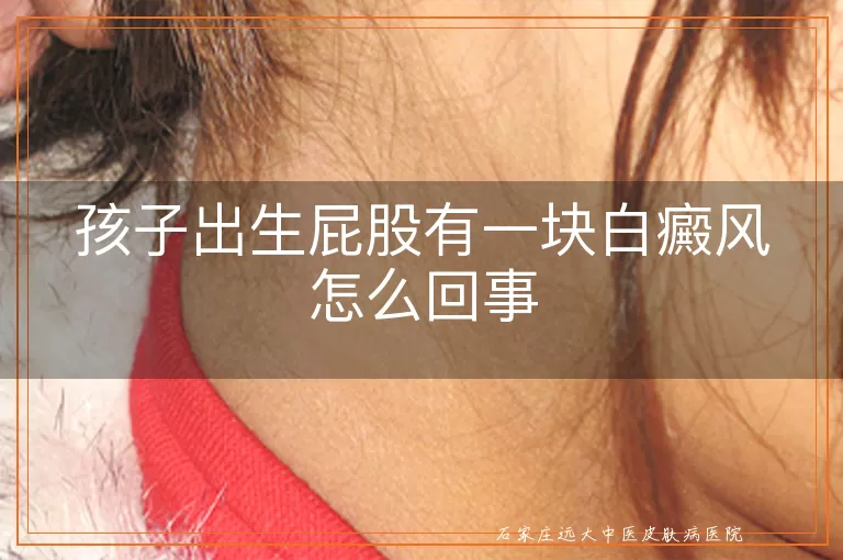 孩子出生屁股有一块白癜风怎么回事
