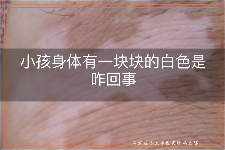 小孩身体有一块块的白色是咋回事