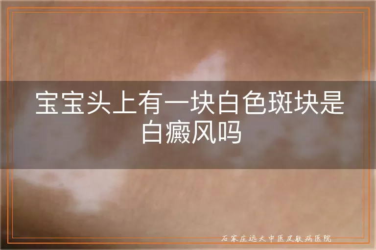 宝宝头上有一块白色斑块是白癜风吗