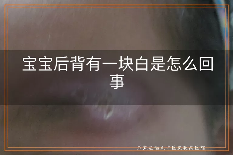 宝宝后背有一块白是怎么回事