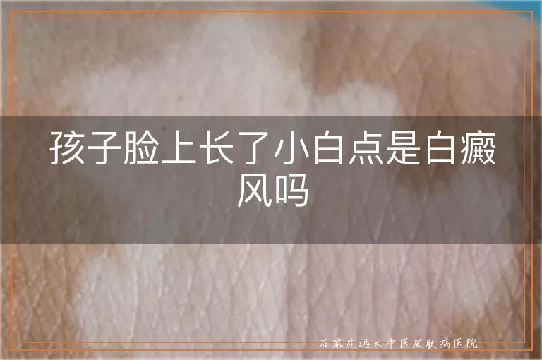 孩子脸上长了小白点是白癜风吗