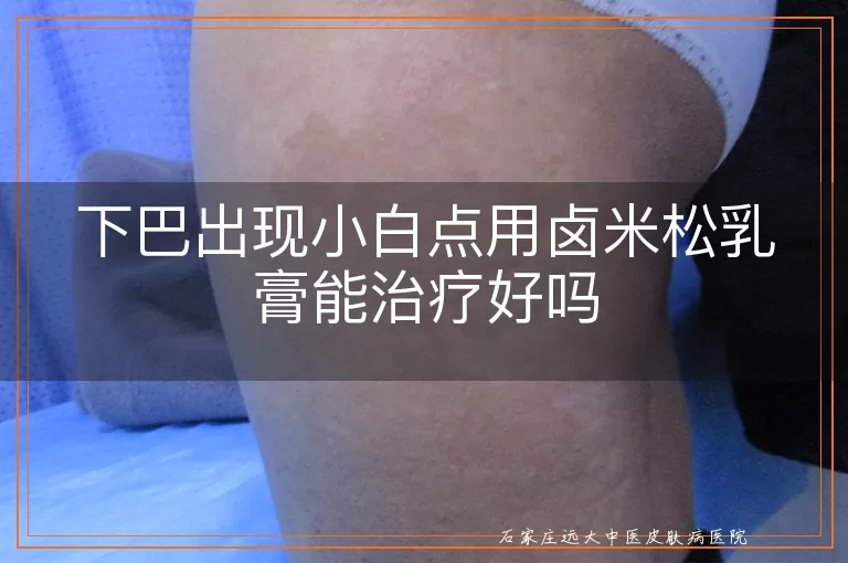 下巴出现小白点用卤米松乳膏能治疗好吗