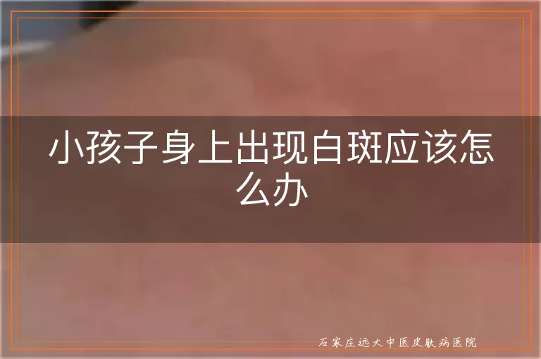 小孩子身上出现白斑应该怎么办