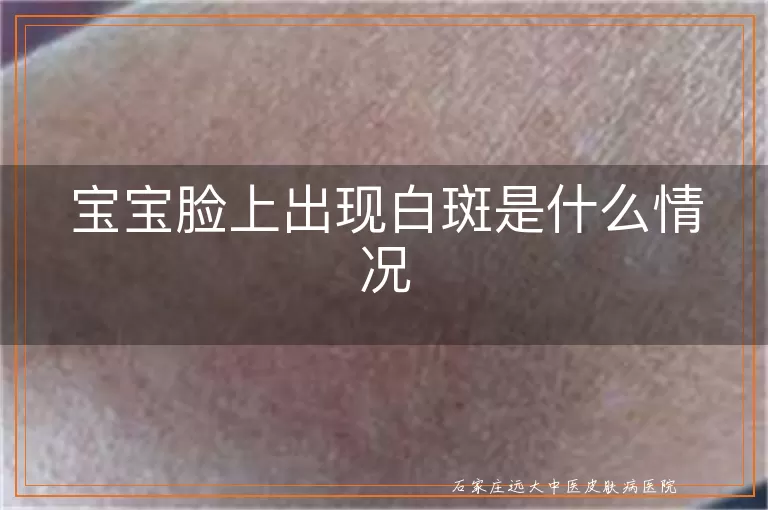 宝宝脸上出现白斑是什么情况