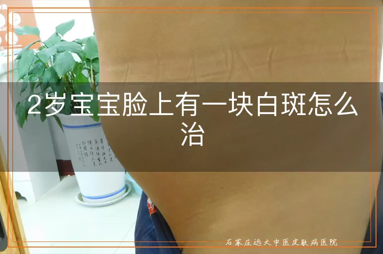 2岁宝宝脸上有一块白斑怎么治