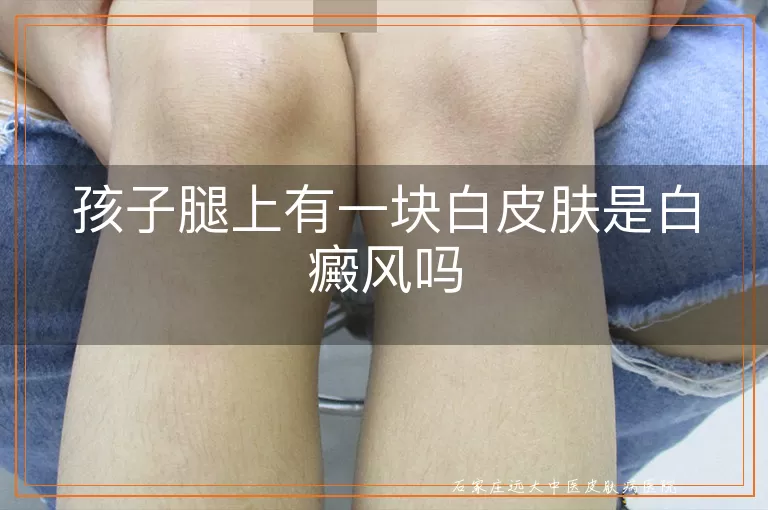 孩子腿上有一块白皮肤是白癜风吗