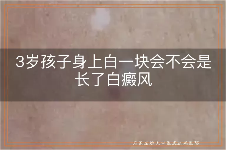 3岁孩子身上白一块会不会是长了白癜风