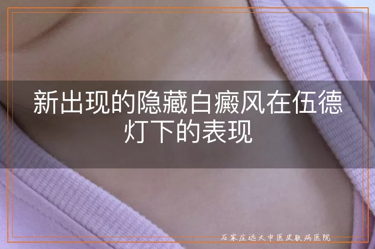 新出现的隐藏白癜风在伍德灯下的表现