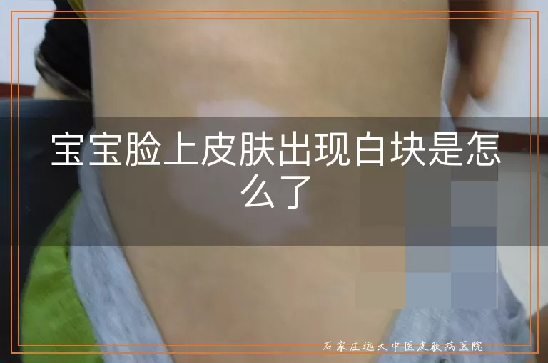 宝宝脸上皮肤出现白块是怎么了