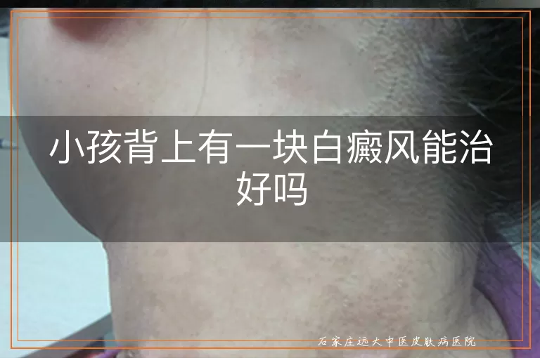 小孩背上有一块白癜风能治好吗