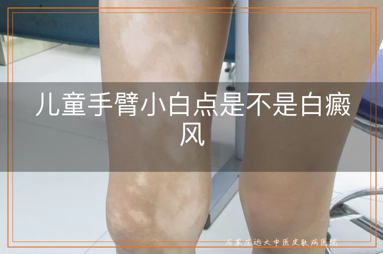 儿童手臂小白点是不是白癜风