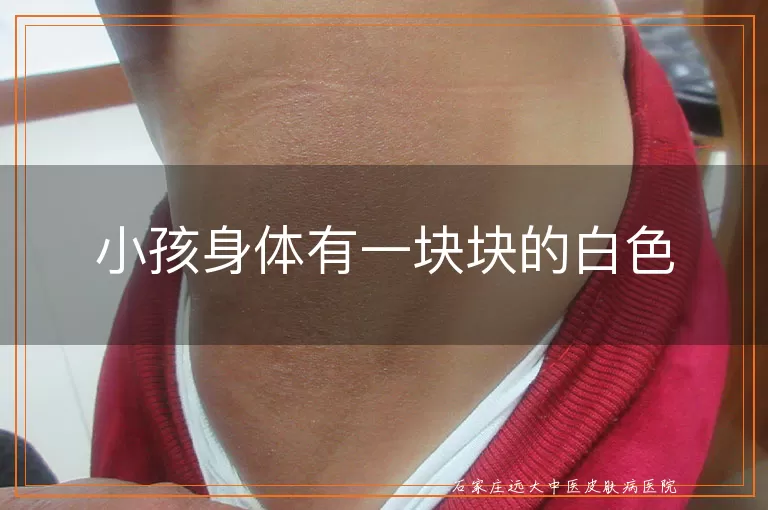 小孩身体有一块块的白色