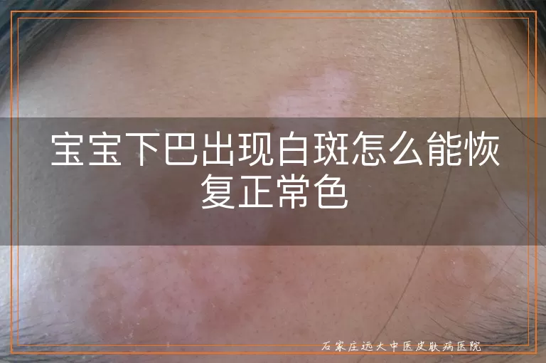 宝宝下巴出现白斑怎么能恢复正常色