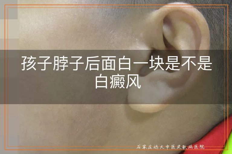 孩子脖子后面白一块是不是白癜风