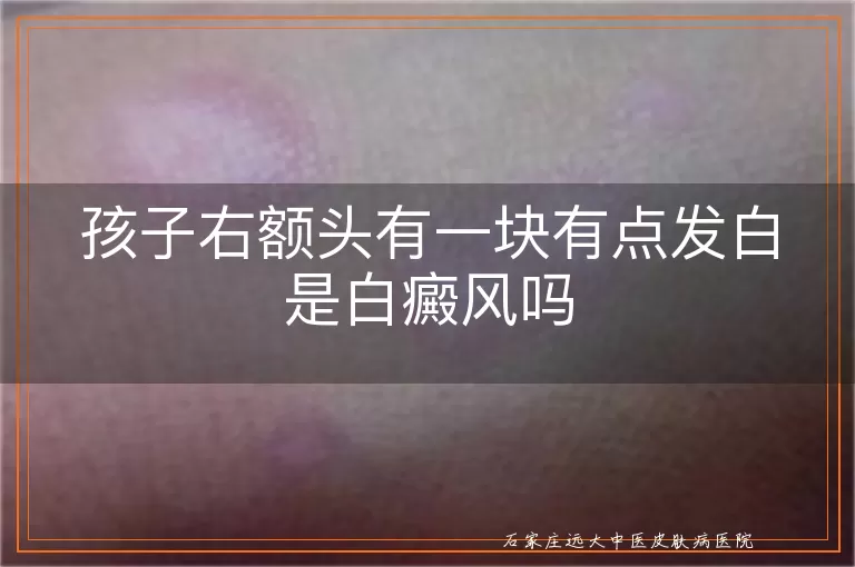 孩子右额头有一块有点发白是白癜风吗