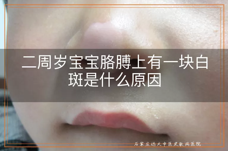 二周岁宝宝胳膊上有一块白斑是什么原因