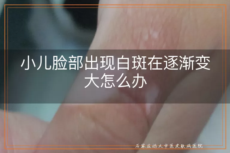 小儿脸部出现白斑在逐渐变大怎么办