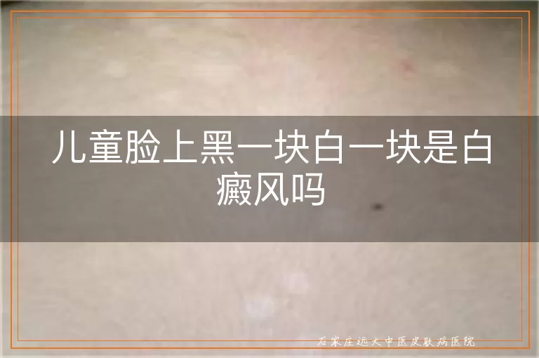 儿童脸上黑一块白一块是白癜风吗
