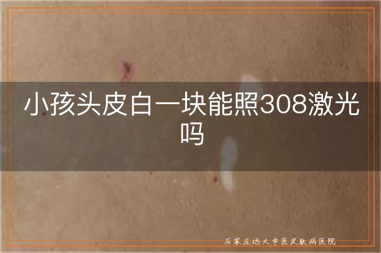 小孩头皮白一块能照308激光吗