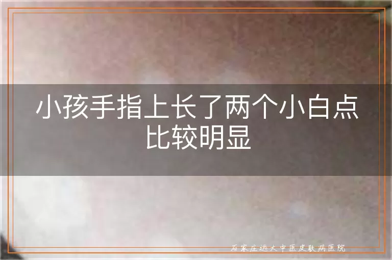 小孩手指上长了两个小白点比较明显