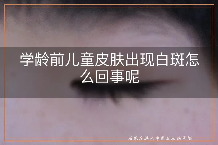 学龄前儿童皮肤出现白斑怎么回事呢