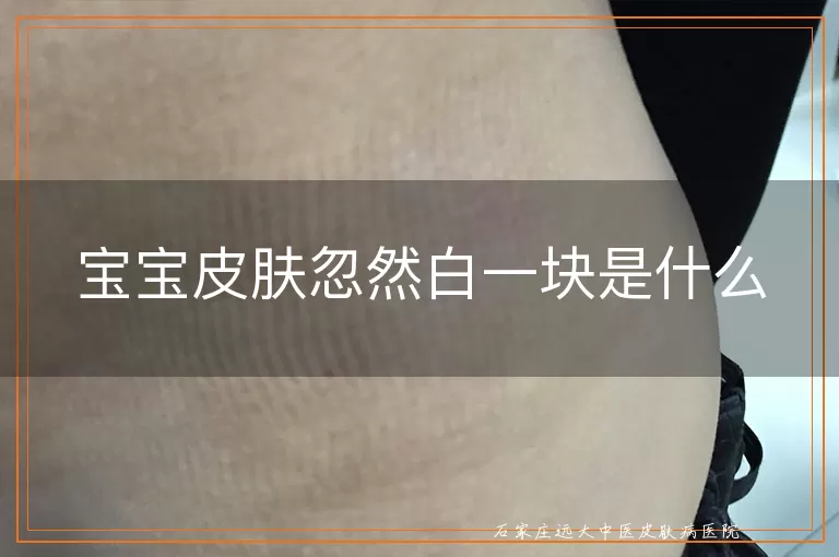 宝宝皮肤忽然白一块是什么