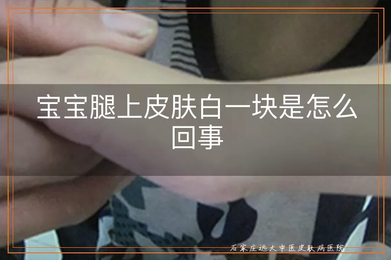宝宝腿上皮肤白一块是怎么回事