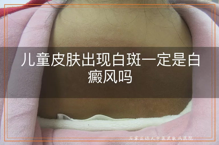 儿童皮肤出现白斑一定是白癜风吗