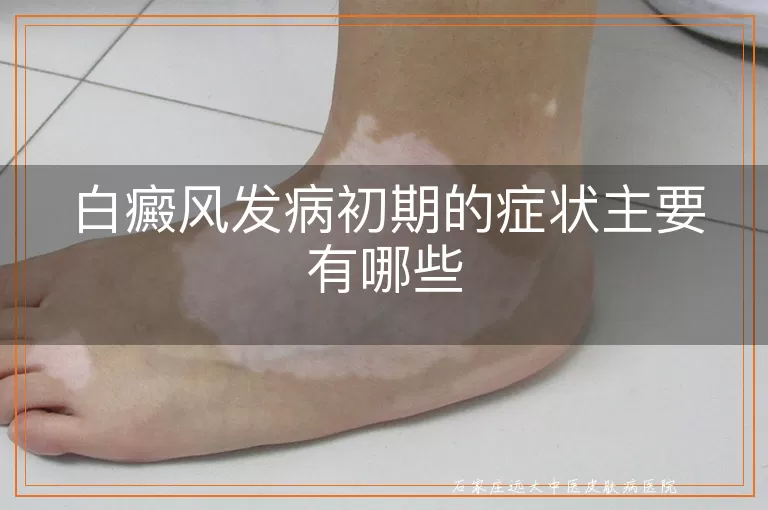 白癜风发病初期的症状主要有哪些