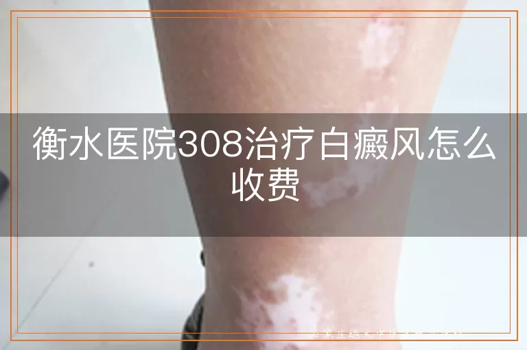 衡水医院308治疗白癜风怎么收费