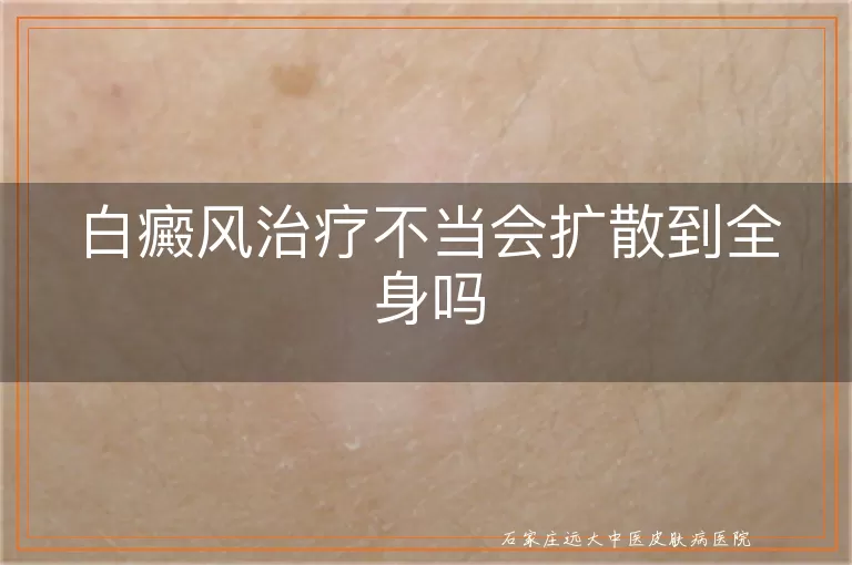 白癜风治疗不当会扩散到全身吗