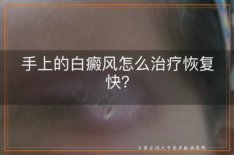 手上的白癜风怎么治疗恢复快？