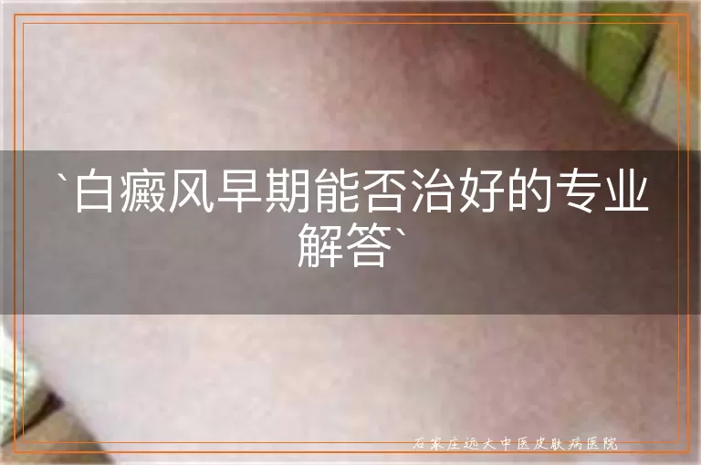 白癜风早期能否治好的专业解答