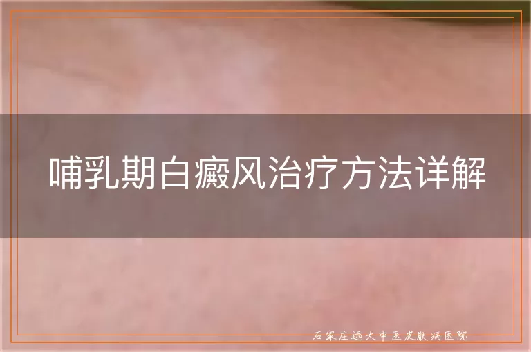 哺乳期白癜风治疗方法详解