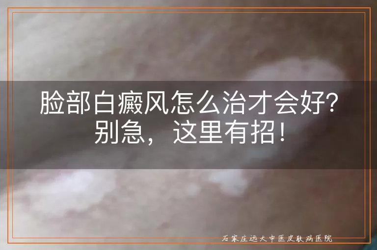 脸部白癜风怎么治才会好？别急，这里有招！