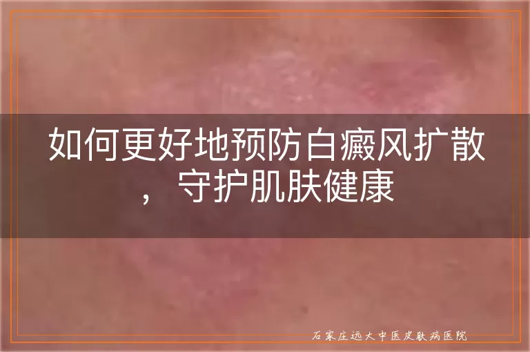 如何更好地预防白癜风扩散，守护肌肤健康