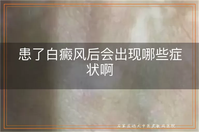 患了白癜风后会出现哪些症状啊