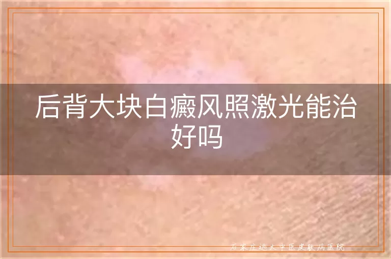 后背大块白癜风照激光能治好吗