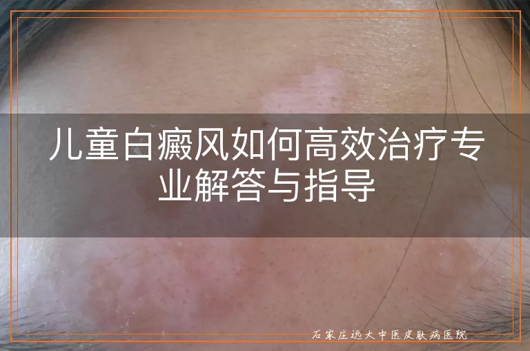 儿童白癜风如何高效治疗专业解答与指导