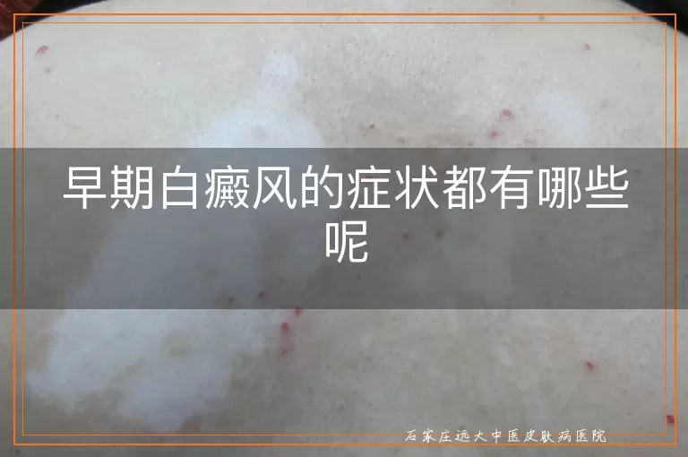早期白癜风的症状都有哪些呢