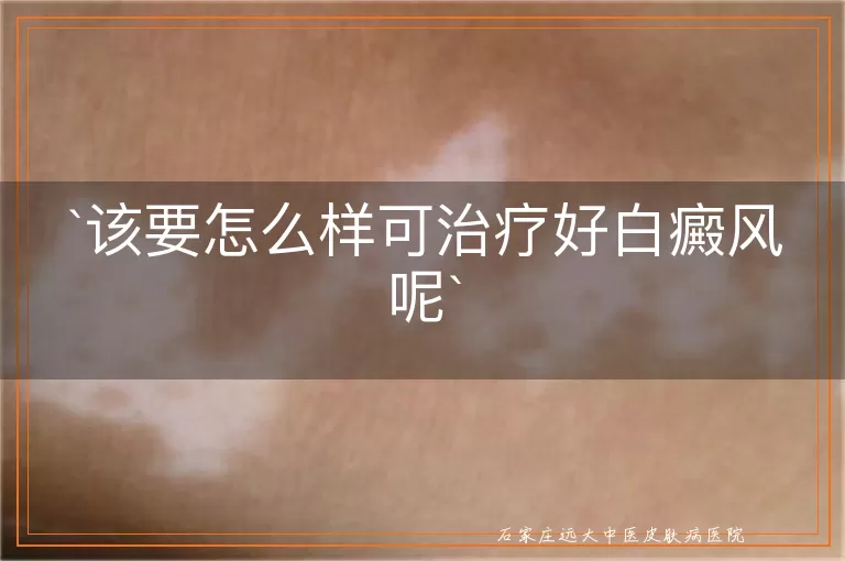 该要怎么样可治疗好白癜风呢